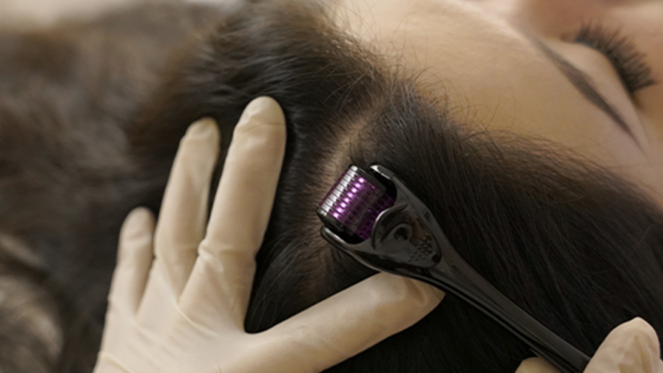Exosomes for Hair Loss in Singapore