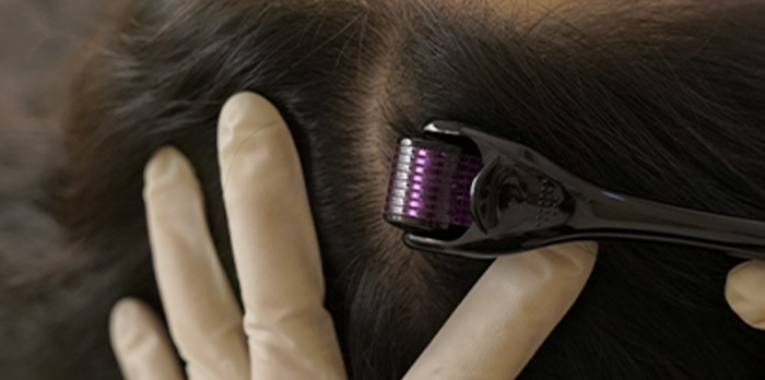 Exosomes Hair Rejuvenation Treatment at Chelsea Aesthetics Exosomes Hair Rejuvenation Treatment at Chelsea Aesthetics