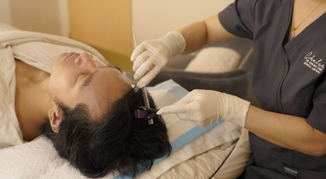 Exosomes Hair Rejuvenation Treatment for Hair Loss Exosomes Hair Rejuvenation Treatment for Hair Loss