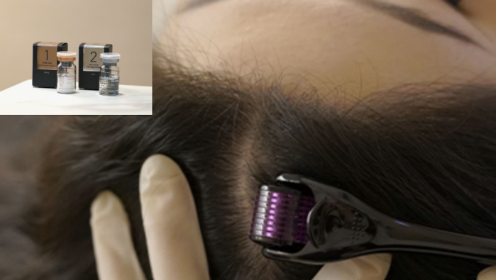 Exosomes Hair Restoration Therapy Exosomes Hair Restoration Therapy