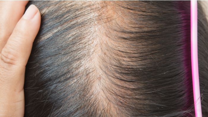 Hair Thinning