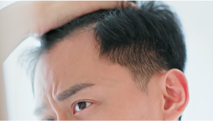 hair loss treatments